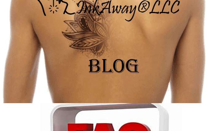 Most frequently asked questions by customers of laser tattoo removal