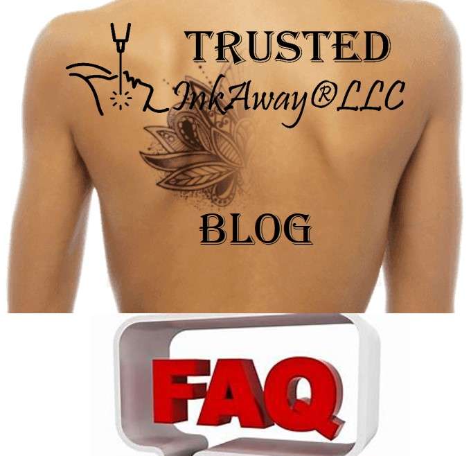 Most frequently asked questions by customers of laser tattoo removal