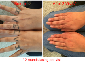 Laser Tattoo Removal Before and After Photos Premium Tattoo Removal