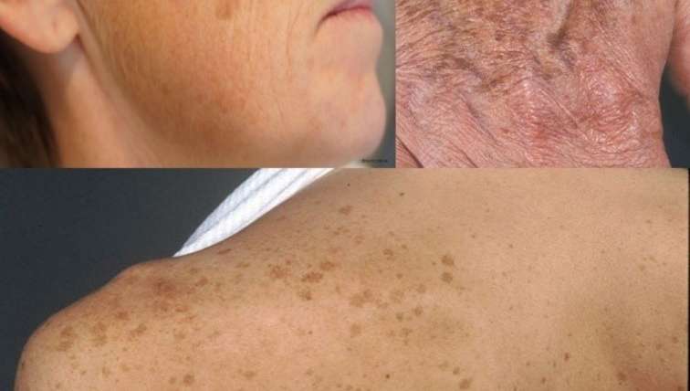 Age spots removal