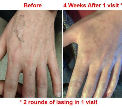 How to look at laser tattoo removal before & after photos?