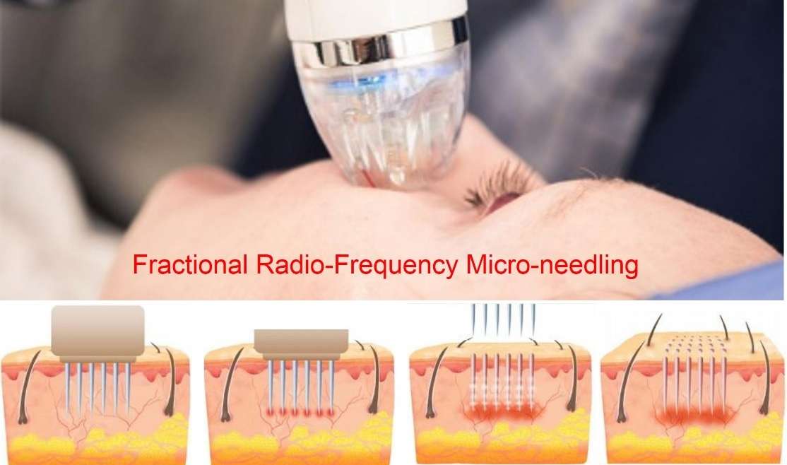 Fractional Radio-Frequency Micro-Needling Skin Rejuvenation