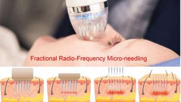Fractional Radio-Frequency Micro-Needling Skin Rejuvenation