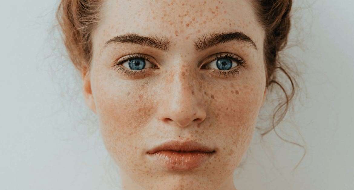 Freckle removal